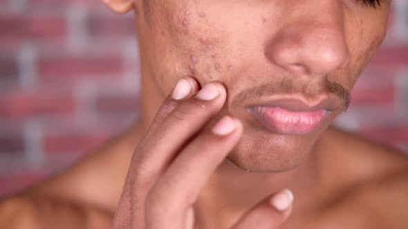 Close Up Young Boy Dermatology Skin Problem