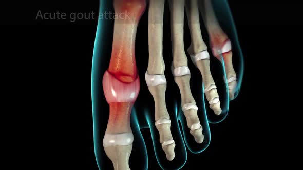 Gout is a form of arthritis. Sudden, severe attacks of pain, swelling occurs