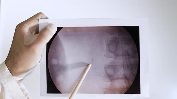 X Ray Of A Kidney With A Stone. A Doctor Analyzes An Oxalate Kidney Stone In A Person.