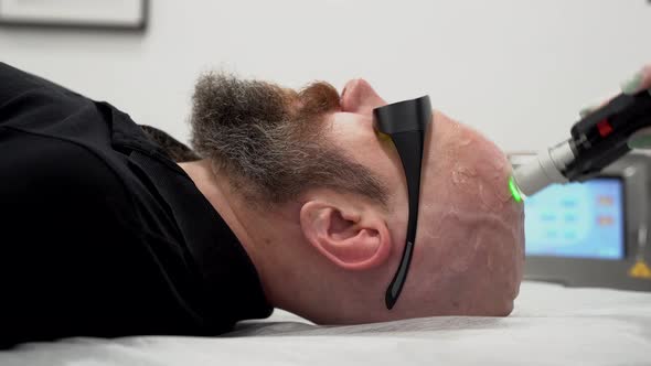 Close Up Bearded Bold Man Head Depilation Laser Hair Removal Procedure Treatment Unpainful Procedure