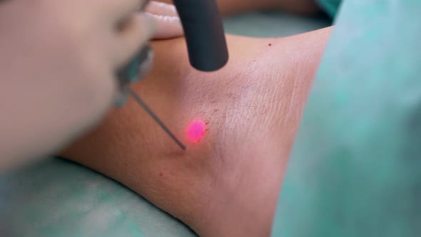 Closeup Beautician Doing a Laser Epilation in Armpit of Woman Lying on Table in Medical Center