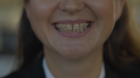 Close-up Toothy Smile of Young Caucasian Woman Wearing Dental Braces. Unrecognizable Positive