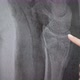 Xray of a Broken Arm in a Gypsum - VideoHive Item for Sale