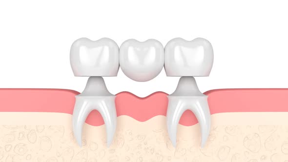 Gums with dental molar bridge over white