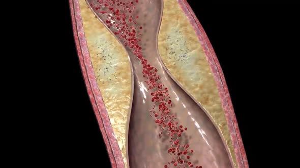 Plaques accumulating in the blood block the coronary arteries