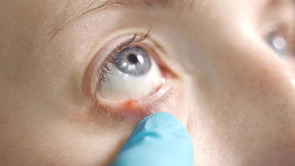 An Ophthalmologist Examines the Eye of a Patient with Blepharitis