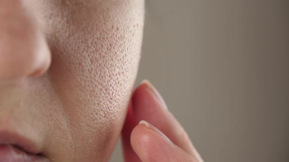 Face Skin with Enlarged Pores Closeup