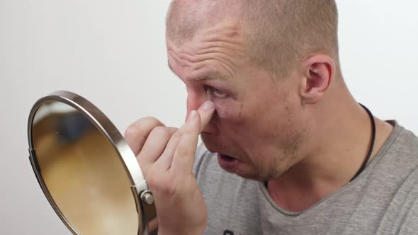 A Man Smears an Ointment on a Black Eye