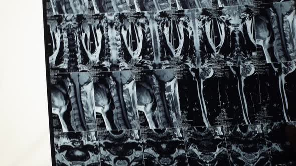 Closeup of Unrecognizable Male Doctor Analyzing MRI Spine Image of Patient Standing By Light Board