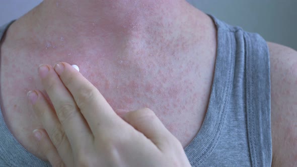 Closeup Shows the Affected Skin Areas with Light Red Pimples