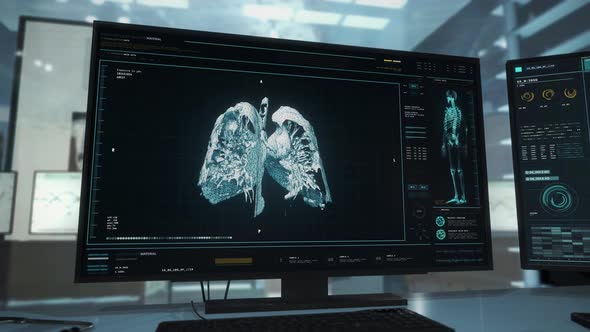 High Tech Organ Analysis Discovers Cancer Disease Infecting Patients Lungs alt
