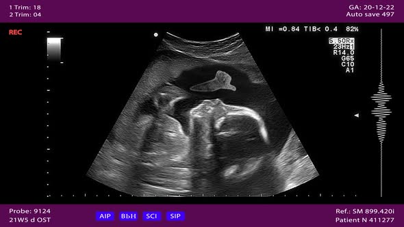 Medical Sonography Display Prenatal Test