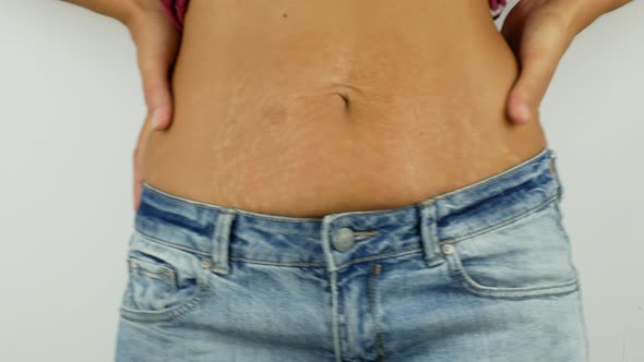 A young woman is showing her weight loss and stretch marks on her stomach.