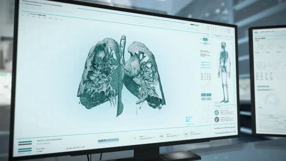 Lung Cancer Found During Advanced Medical Examination Of Patients Breast alt