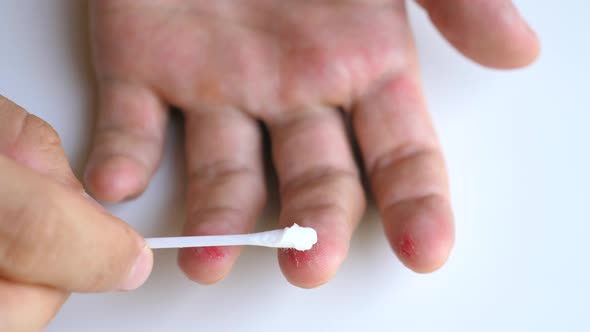 Male Arm Apply Medicinal Ointment By Cotton Swab on Injured Sore Fingers