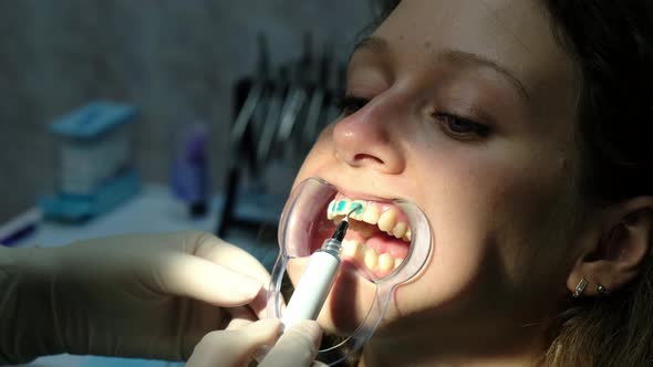Dentist Applies a Special Orthodontic Blue Glue on the Teeth To the Woman in the Latch Before