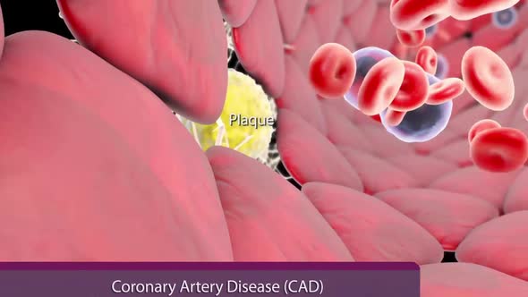 Plaque formation in the cardiovascular tract