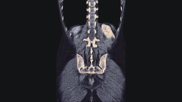 Voluminous Color MRI of the Female Pelvic Organs Abdominal Cavity Gastrointestinal Tract and Bladder