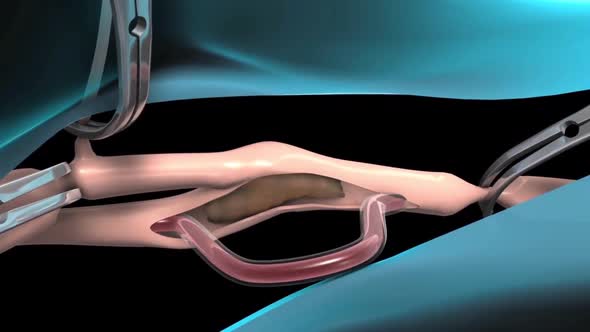 Removal of plaque formed inside the carotid arteries