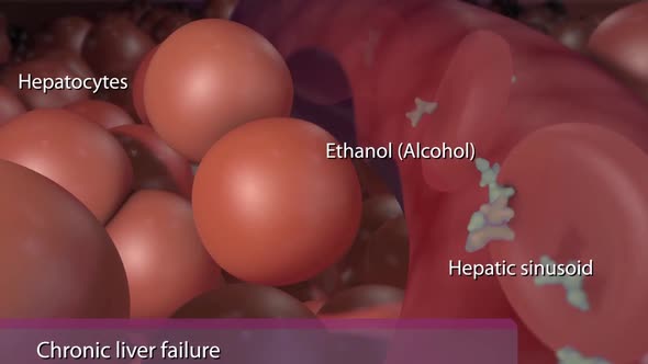 Chronic liver failure caused by alcohol.