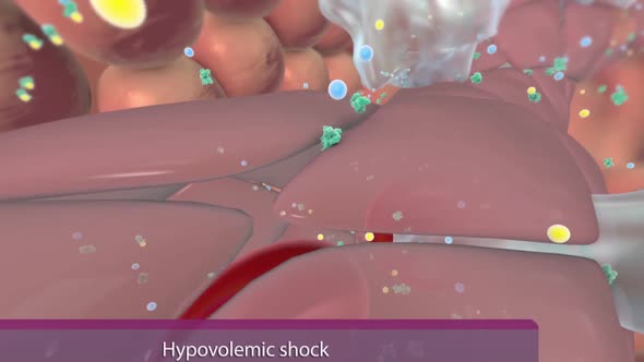 Hypovolemic shock occurs due to low fluid volume in the intravascular system.