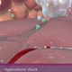 Hypovolemic shock occurs due to low fluid volume in the intravascular system. - VideoHive Item for Sale