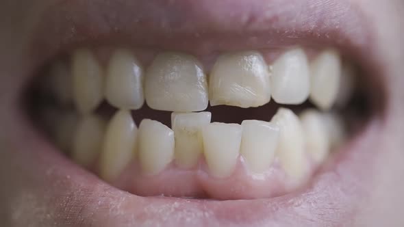 A Man Shows His Crooked Teeth