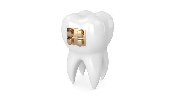Tooth with  golden orthodontic braces