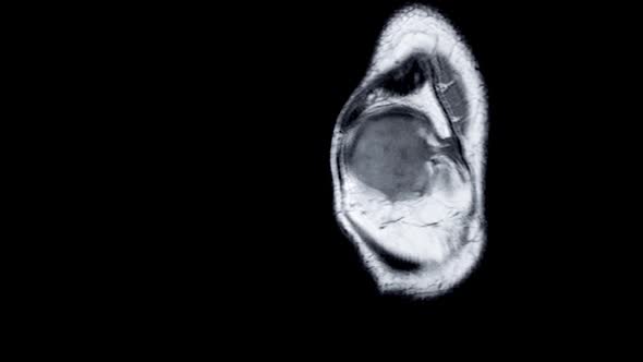 Magnetic Resonance Imaging (MRI) of Right Knee