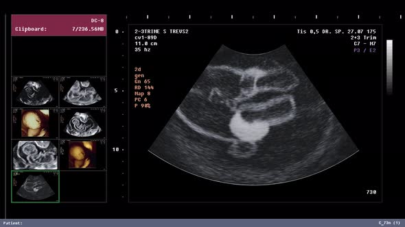 X-ray analysis system at hospital determines female sex of an unborn child alt