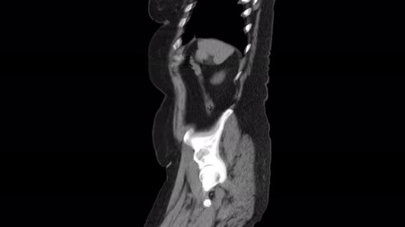 Purified MRI of the Abdomen, Gastrointestinal Tract, Bladder