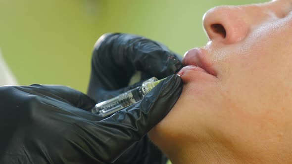 Senior Woman Gets Injection of Hyaluronic Acid in Her Lips