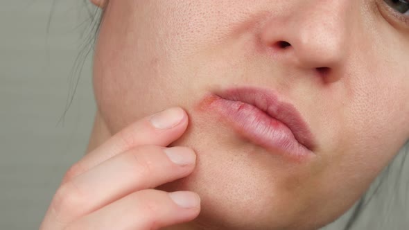 Female Face Close-up with Herpes Virus Disease. The Hand Touches the Inflammation of Herpes