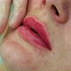 The Cosmetologist Makes Injections on the Client's Face in the Lip Area - VideoHive Item for Sale