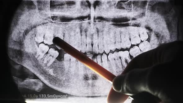 Dental X-Ray of Jaw with Teeth. Sealed Molars. Dentist Examines the Dental Arch