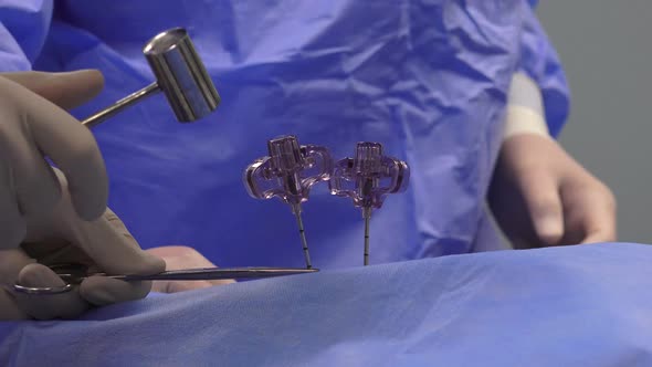 Spine Vertebroplasty Procedure 2