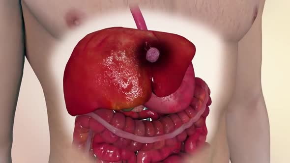 Effects of colon cancer on liver. 3D Medical Animation