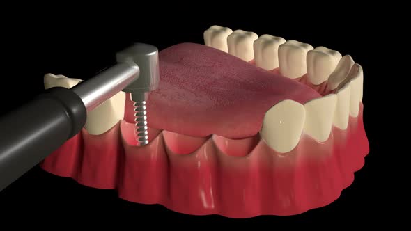 Implant Supported Dental Bridge