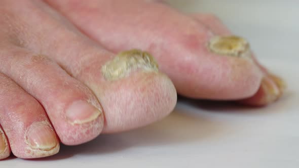 Skin diseaseClose Up of Nail Fungus Toe Fungus Foot Dermatitis