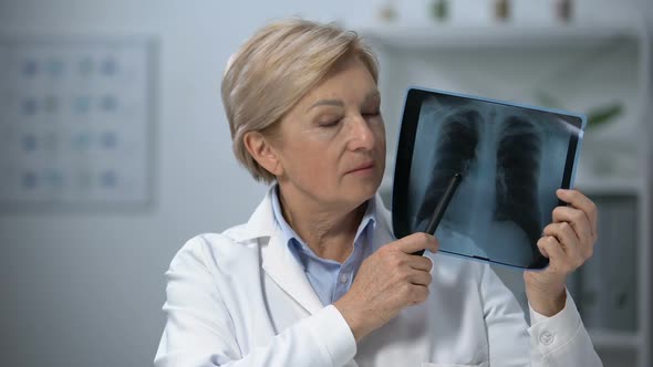 Aged Female Physician Looking at Lungs X-Ray and Shaking Head, Bad Scan Result