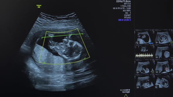 Ultrasound of Pregnant Woman