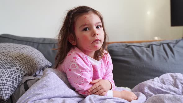 Toddler Girl with Chickenpox Measles on the Body