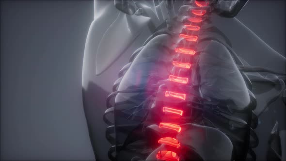 Backache in Back Bones alt