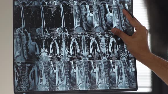 Closeup Back View of Professional Male Doctor Analyzing MRI Spine Image of Patient Standing By