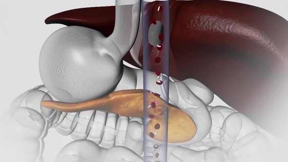 Diabetes is a metabolic disorder caused by high levels of blood sugar.