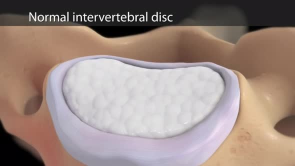 Top view of normal intervertebral disc