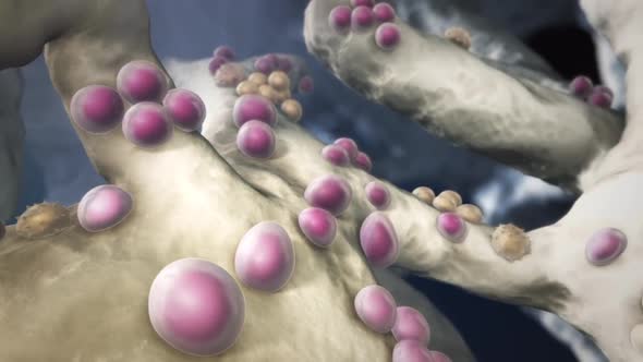 Plasma cell neoplasms occur when abnormal plasma cells form cancerous tumors in bone or soft tissue