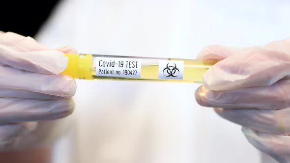 Corona Flu Virus Testing Samples in Vial