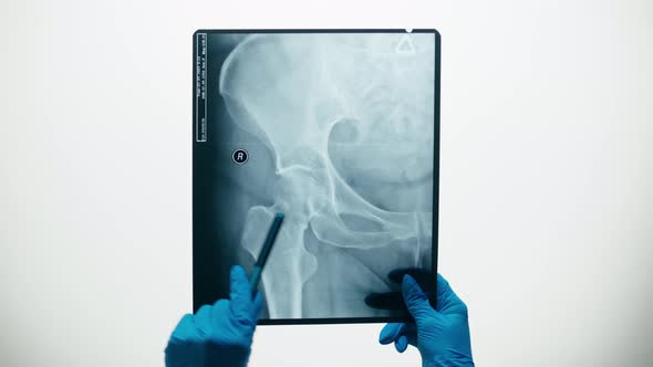 Pelvic Hip Xray Closeup