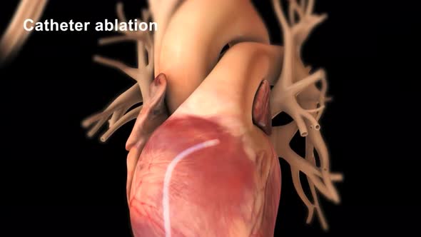 Catheter ablation is the treatment of arrhythmia with radio waves.